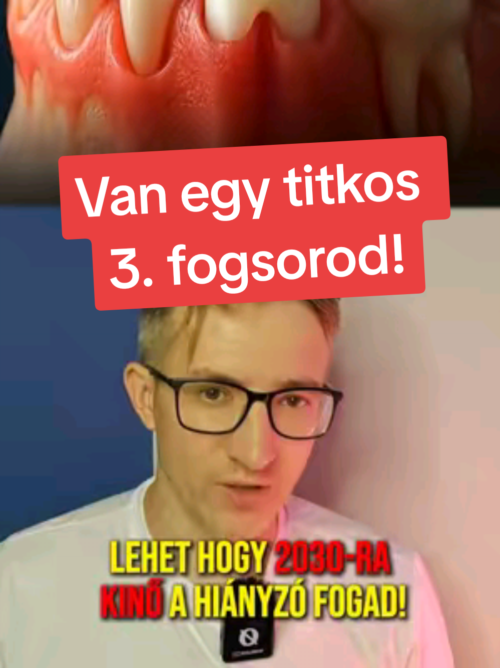 Kevesen tudják, de az embernek valójában három fogsora van. Japán kutatók most egy gyógyszert fejlesztettek ki, ami képes lehet aktiválni a rejtett fogsort. Ha működik, a jövőben elég lehet egy szuri, és kinő a saját fogad! 🦷 Kipróbálnád ezt a módszert, ha hiányozna a fogad? ✅ Igen ❌ Soha – írd le kommentben! #3fogsor #tudomány #wtf #jövő #orvosiáttörés