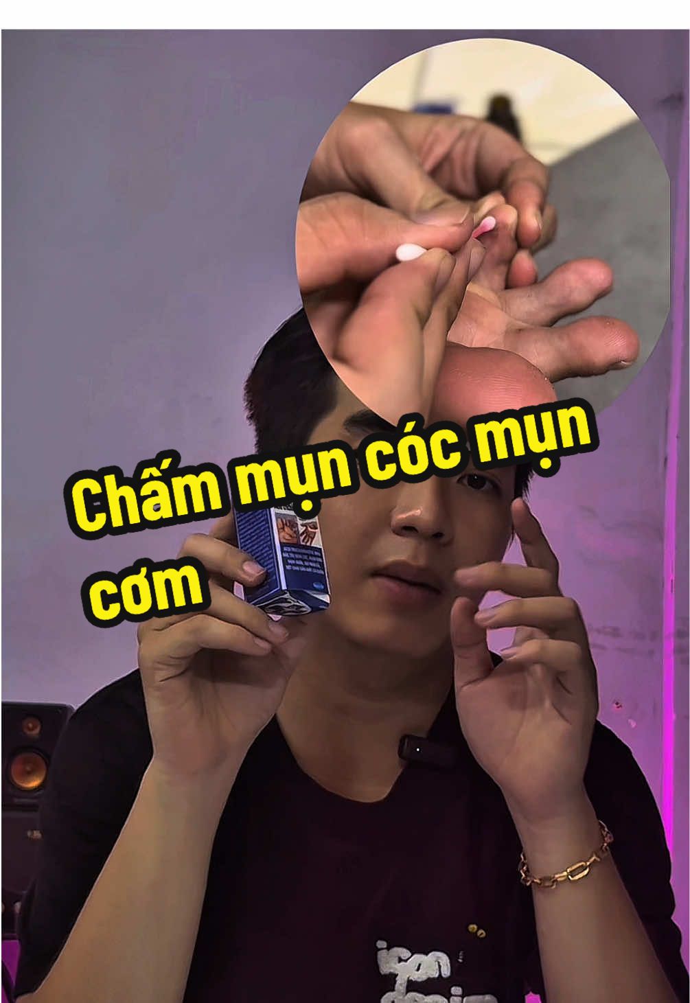 Mụn có  mụn cơm bay cả gốc lẫn rễ #muncoc #muncom 