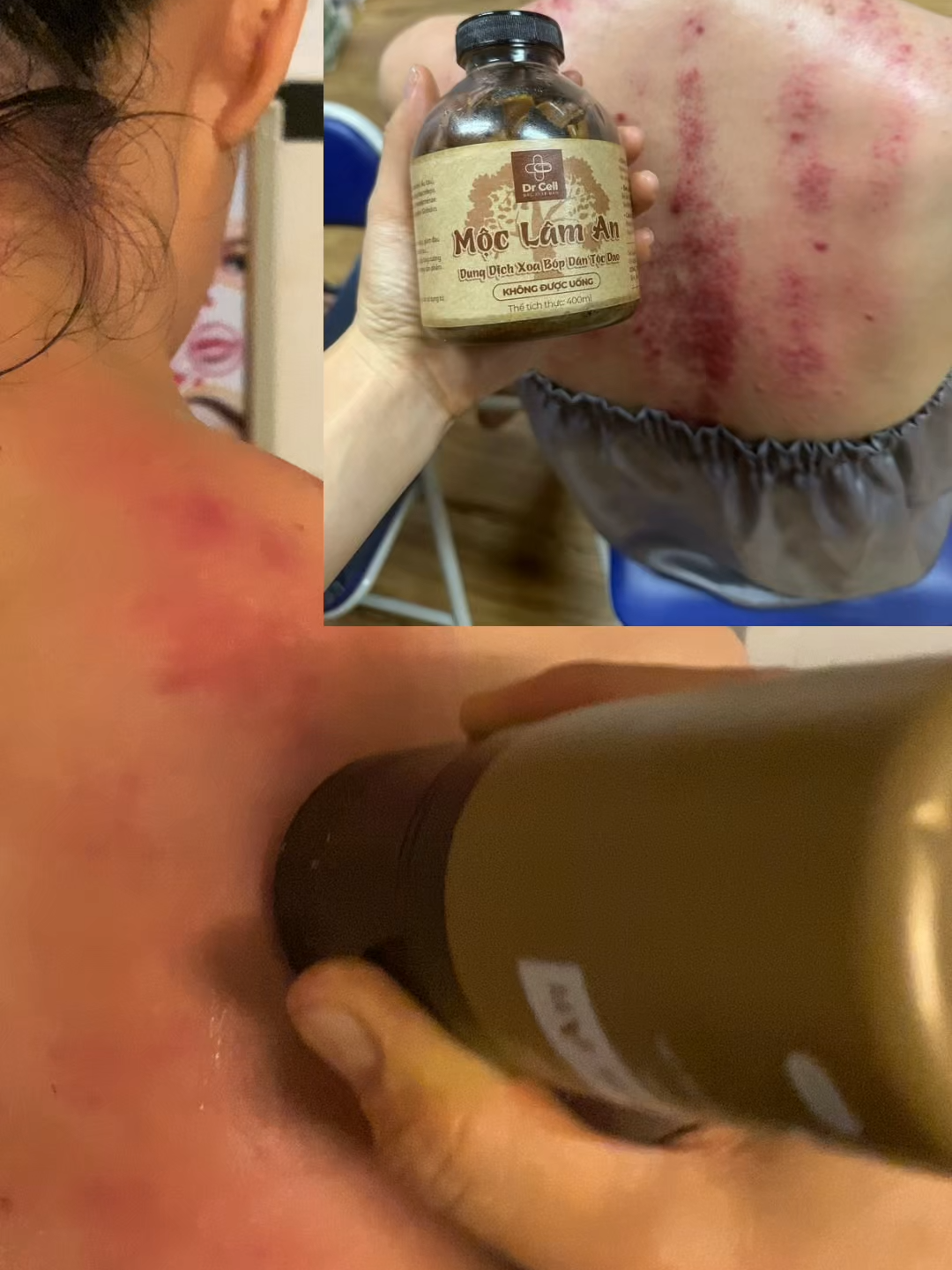 Cạo gió bài hàn khí ngay tại nhà với lăn Mộc Lâm An! Sản phẩm được làm từ 9 loại thảo dược quý, giúp giảm đau nhức, đặc biệt hiệu quả với vùng cổ vai gáy. Lăn tới đâu, nhẹ người tới đó! #MocLamAn #dauvaigay #caogio #baithuocdantoc #thuocxoaobop