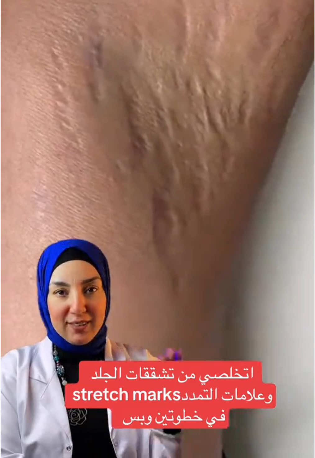 ازاي نتخلص من علامات تمدد الجلد stretch marks @VIVA INTERNATIONAL PHARMA  #stretchmarks 
