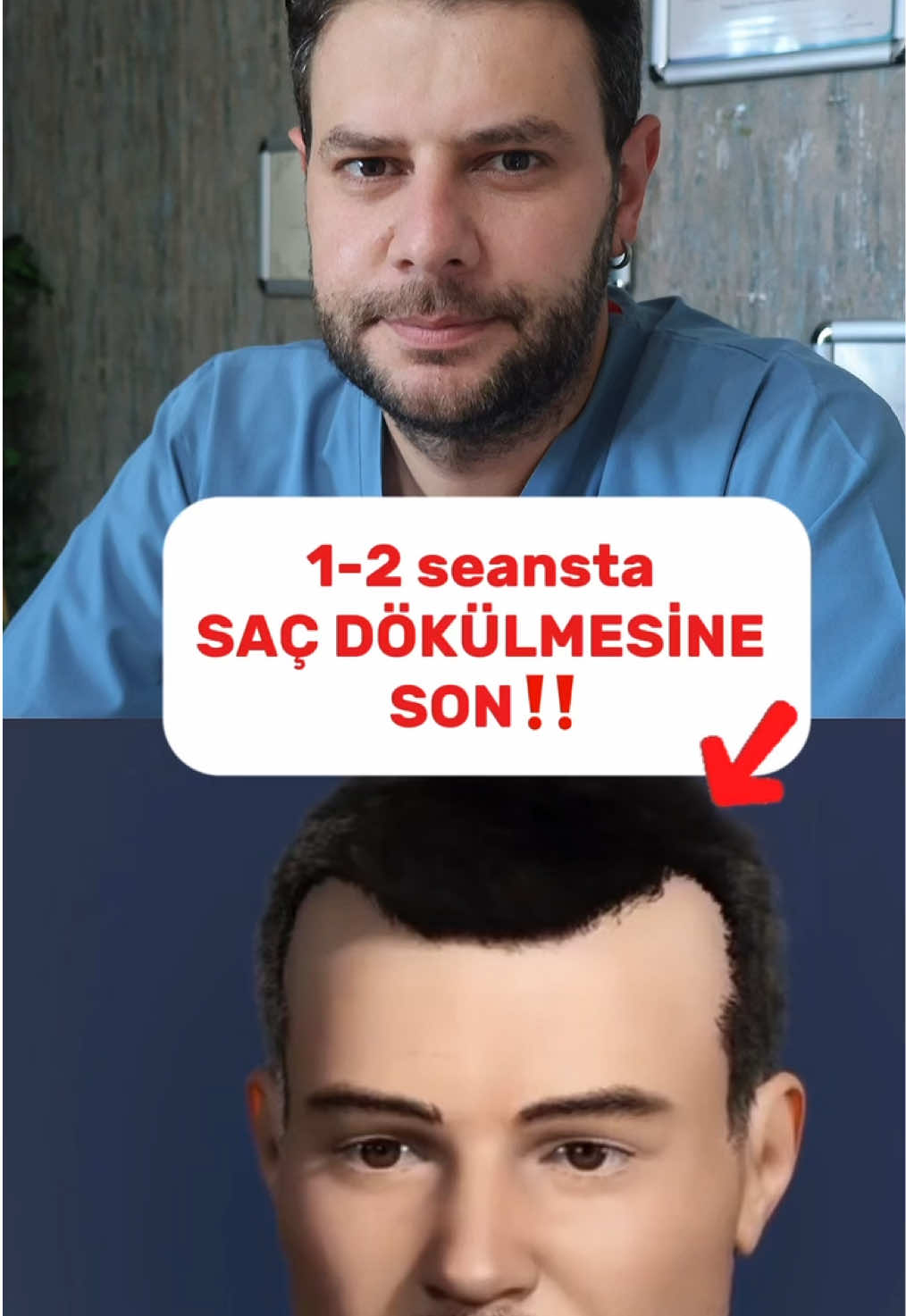 Eksozom, kök hücrelerden elde edilen bir tedavi. Saçlı deriye uygulanıyor. Saça Faydası: Dökülmeyi durdurur Yeni saç çıkarır Saçı kalınlaştırır Saç derisini iyileştirir Saça canlılık, hacim ve parlaklık katar Genetik dökülmede bile etkilidir. Bu içerik yalnızca genel sağlık bilgisi vermek amacıyla hazırlanmıştır. Tanı ve tedavi yerine geçmez. Tıbbi şikayetleriniz için mutlaka hekiminize başvurunuz. #saçdökülmesi #saçdökülmesinekarşı #saçekimi 