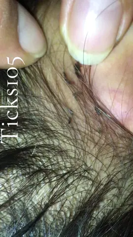 remove to stop itching#😭😭😭 #😱😱😱omg #liceremoval #🥶🥶🥶 #😍😍😍 