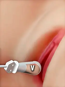 V-Tone Therapy – Strengthening from Within #vtone #vtonetherapy #womenshealth #pelvichealth #wellnesscare #doctorexplains #medicalfacts #healthawareness #medical3danimation #medicalanimation 