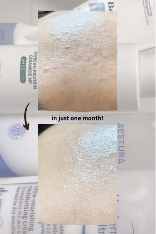 Years of fighting tiny bumps... ⠀ I tried EVERYTHING, but this routine is the real deal! ⠀ ✅ Week 2 → skin starts changing ✅ Week 4 → skin feels stable ✨ ⠀ STEP 1. Cleansing 🫧 @make p:rem global Relief Moisture Cleansing Milk → gentle AM/PM @belprimo Hyal Calming Foam → fluffy & hydrating ⠀ STEP 2. Skincare @AESTURA Atobarrier Hydro Essence → barrier boost + layers of hydration @Bioderma_me Atoderm Cream (or @cetaphil Moisturizing Lotion) → lock it in 🔒 ⠀ 👉Save this routine&say bye to forehead bumps! ⠀ ⠀ #skincaretips #koreaskincare  #kbeautyskincare #bumps #skincareproducts 