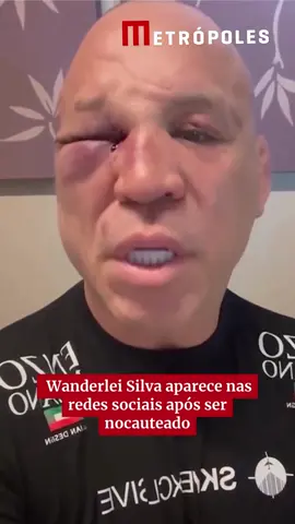 Após ser nocauteado em briga generalizada, no Spaten Fight Night, nesse sábado (27/9), Wanderlei Silva utilizou as redes sociais para se pronunciar. O ex-atleta de MMA e Popó estavam por conta da luta principal do evento de boxe. No entanto, Wand levou três advertências e árbitro encerrou o duelo, dando a vitória ao tetracampeão mundial de boxe, o que incitou uma confusão entre as equipes. No vídeo, Wanderlei mostra o grave hematoma no olho e diz que está sofrendo com dores de cabeça. Ele descreveu a situação como covarde ao afirmar que a equipe de Popó que teria incitado a confusão. “Levei um soco na nuca e outro no olho. Só estava separando [a briga] e apanhei”, disse o atleta. 📹 reprodução/ rede social