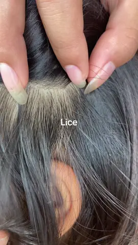 😱😱#liceremoval #lice 