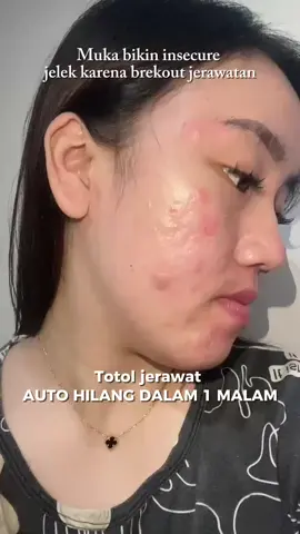 Permasalahan kulit aku yg tdk kunjung berhenti sampe akhirnya aku menemukan solusinya🤩, karena pake obat totol jerawat ini jadi bersyukur banget😘 tonton video sampe akhir yaa✨ #drleo #drleoid #acnebuster #acneessence #acnetreatment 