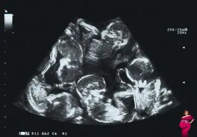 #pregnant #ultrasonic #quintuplets 