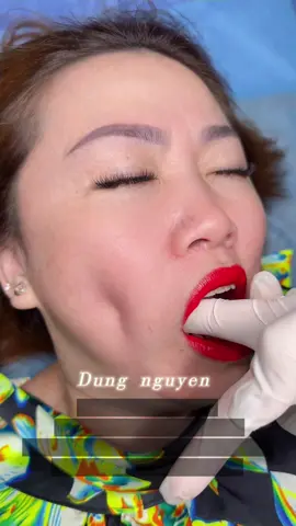#nhấn_má_lúng_đồng_tiền #dungnguyen #chiasekinhnghiem #làmđep #xuhuong 