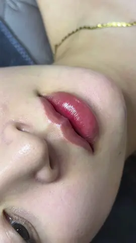 Hệ môi camera thường 🥰#fillerbottoxchuanykhoa #f #foryou #môixinh #tiemfiiler 