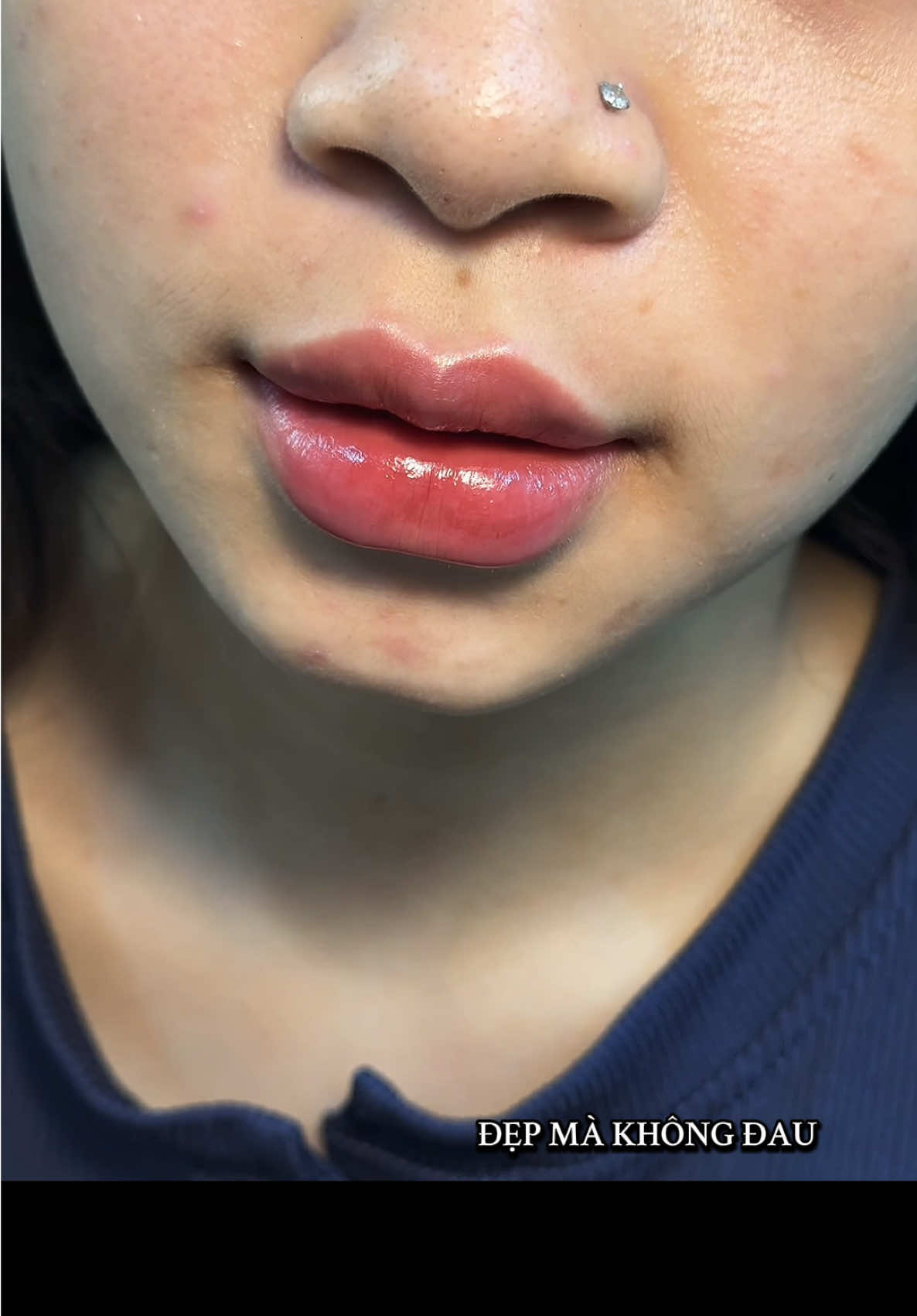 Filler chỉ 0.6 cc đã có môi xinh rồi.  Đẹp mà k đau k tím là có thật.😊