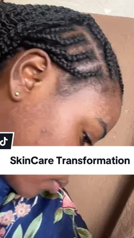 I’ve been battling with this tinea versicilor,acne and pimples plus post inflammatory hyperpigmentation for soo long and Now i am free🥹❤️ #skincaretips101 #skincareglowup #acnefree 