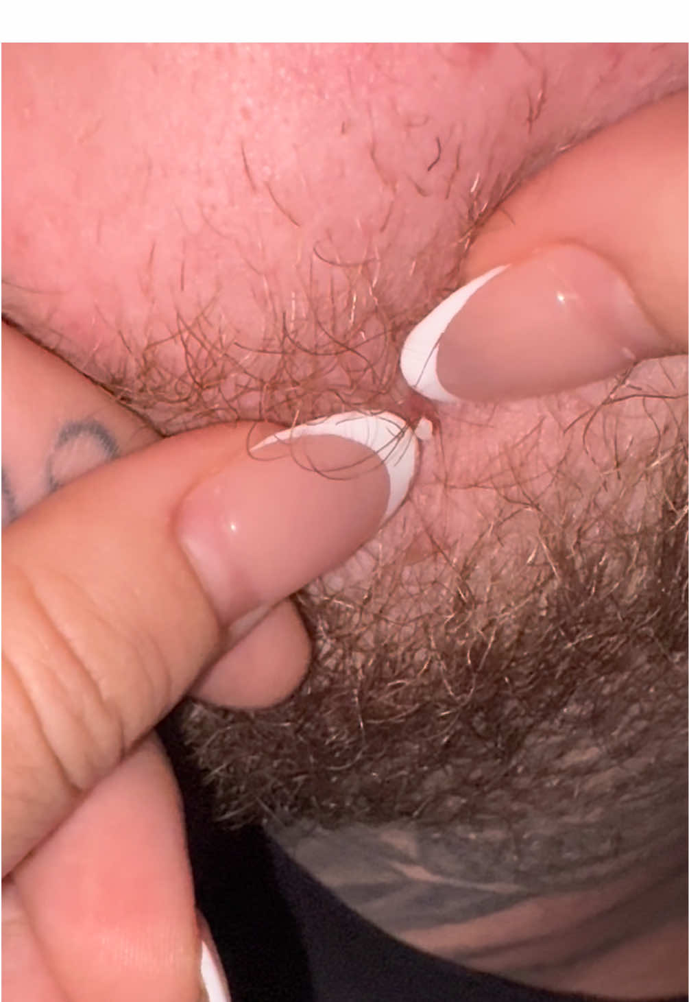 Why so satisfying 😅#spotpopping #satisfyingvideos #pimples #pimpleasmr #pimplepopper 