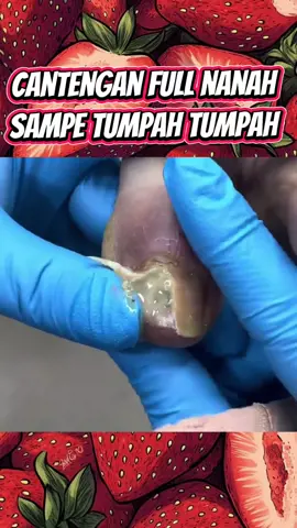 cantengan dengan full nanah adalah video yg sangat satisfying..selamat menikmati #cantengan #ingrowntoenailsurgery #guntingkuku #nailfungus #fyp 