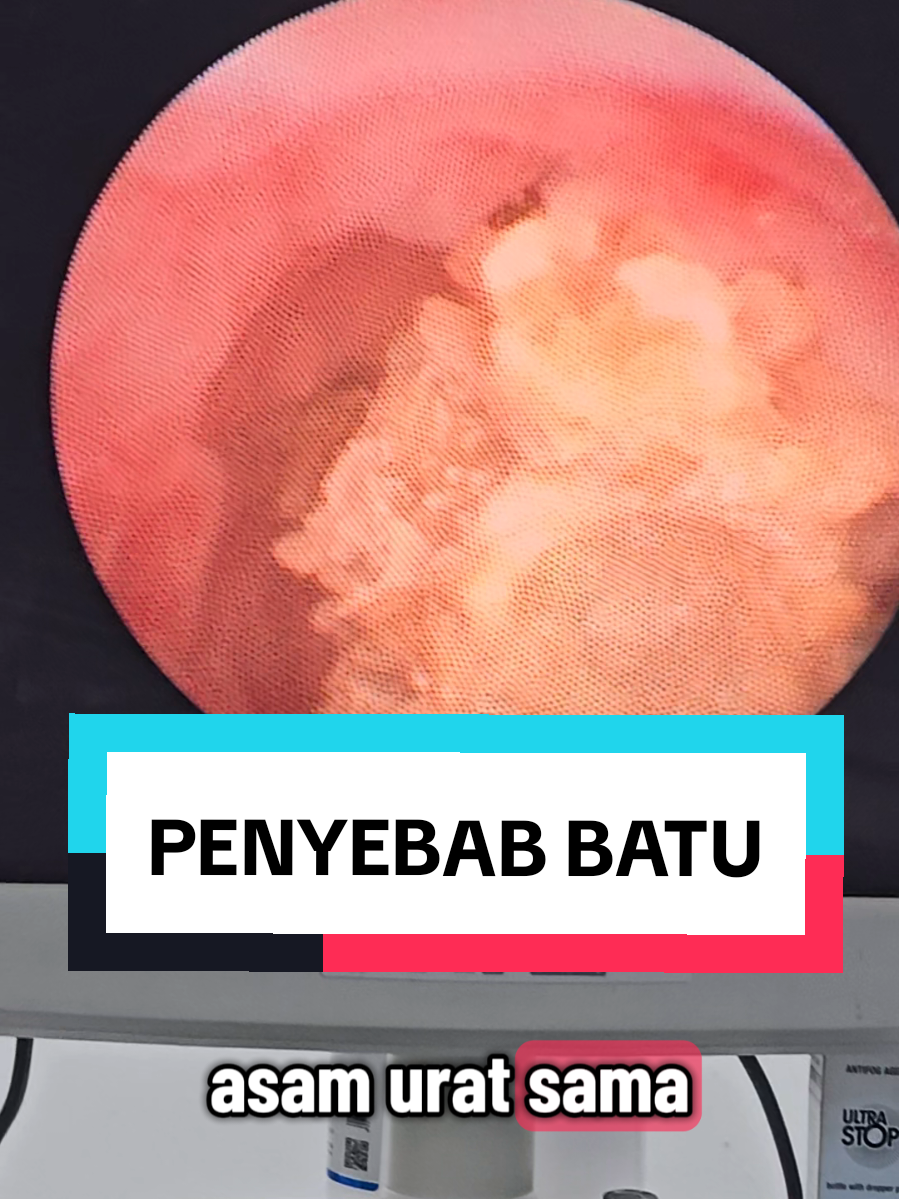 Replying to @user6750481431081  sorry gaess mic nya kemaren abis batere, jadi kencengin aja volumenya yah kalo suara saya kurang terdengar🙏✌️😁 #batuginjal #rirs #urs #urologi #siloambalikpapan 