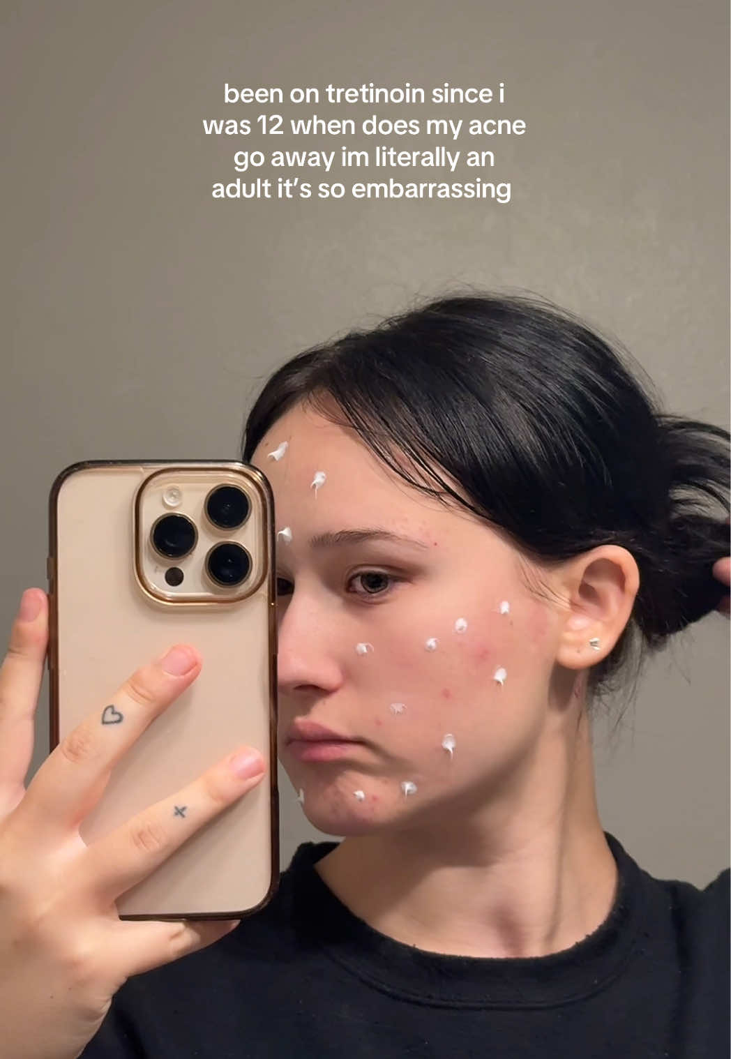 #acne #adultacne #tretinoin #skincare #helppp 
