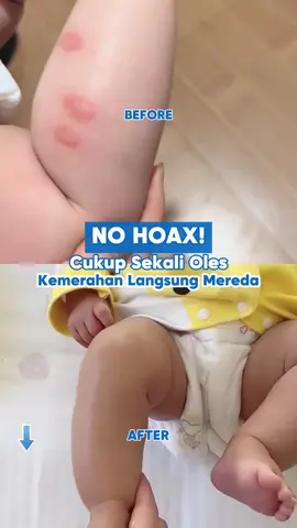 Ini beneran bisa meredakan kemerahan loh Bund🤩  #kittymom #skincarebayi #viral #gajiansale #multicare #babycare #viral #fyp #skincareanak #skincareroutine #multicream #bodycare #skincareviral 