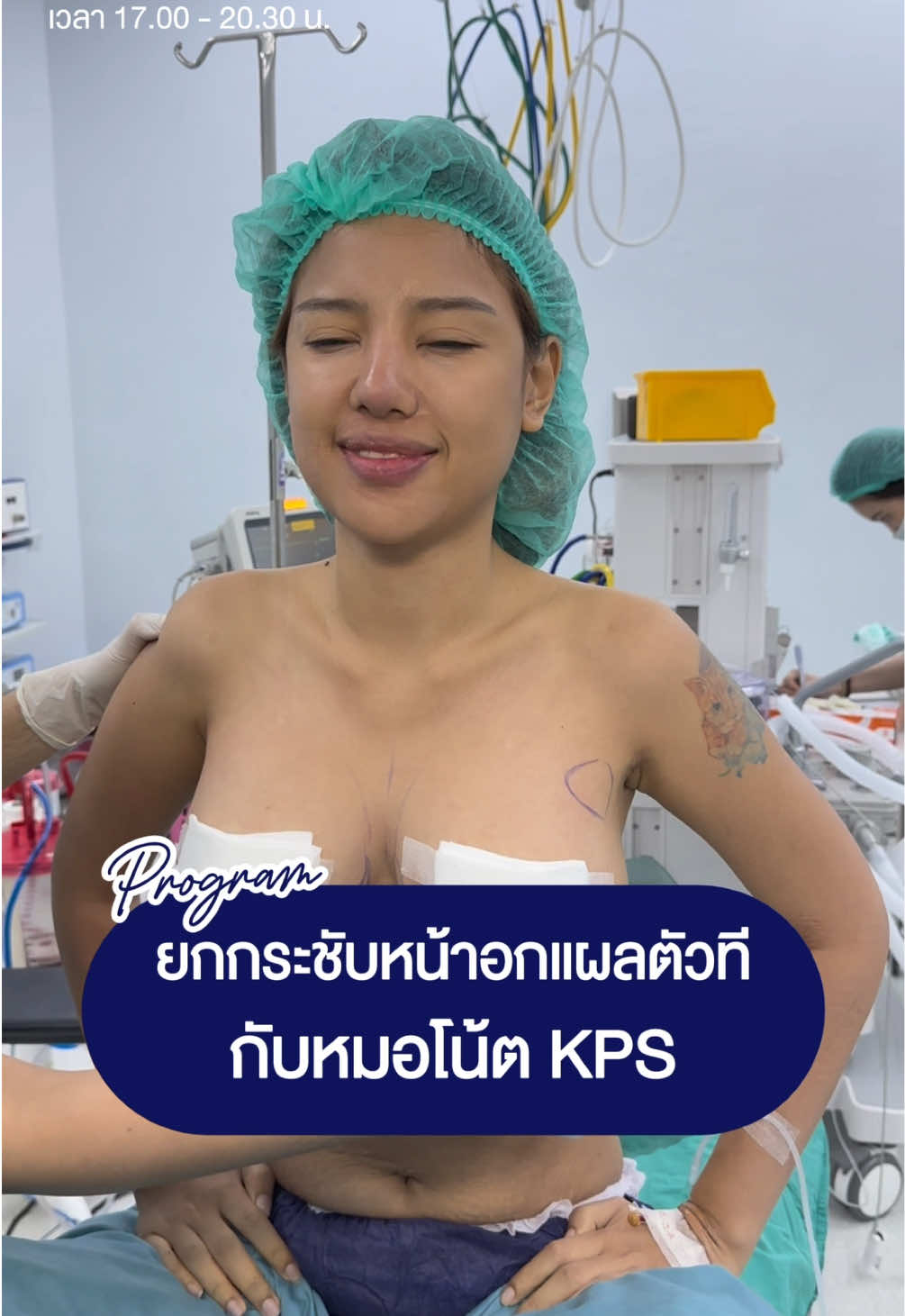 มาดูกันครับ ‘น้องจูน ลูกสาวพี่เก่งลายพราง❗️‘  วันนี้มาลดไซซ์แล้ววว👙 #หมอโน้ตkps #นมต้องโน้ต #แก้หน้าอกหมอโน้ตkps #ยกกระชับหน้าอกหมอโน้ตkps #KPSkasemradplasticsurgery 