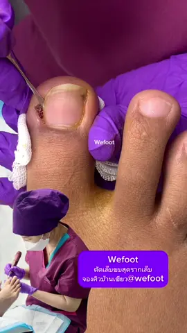 เล็บขบเหลือตอ#ingrowntoenail #wefootตัดเล็บขบรักษาเล็บเชื้อรา #ตัดเล็บขบมียาชา #ตัดเล็บขบ #เล็บขบ 