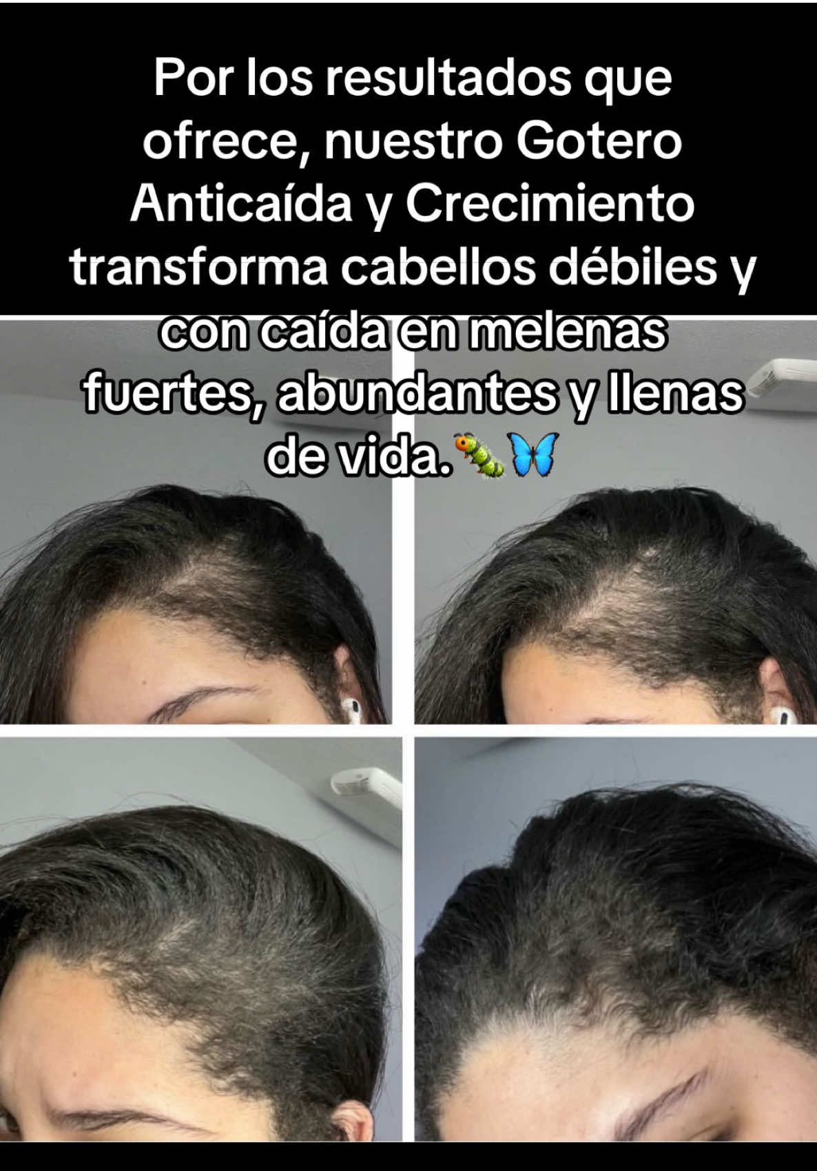 #crecmiento #anticaida #gotero #paratipage #fypシ゚viral 