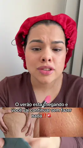 Minha autoestima é outra 🥹🤌🏻#cuidadoscomapele#insegurança#estrias#lipedema#celulite
