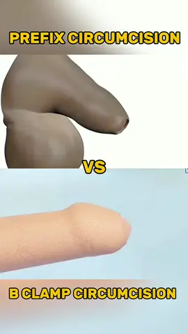 B clamp vs prefix circumcision which one do you choose?  “Circumcision is a common surgical procedure performed for cultural, religious, or medical reasons, and our goal is to share clear educational content to help you stay informed about health choices. 🌿✂️ This post is for educational purposes only and should not be taken as medical advice—always consult a qualified healthcare professional for diagnosis and treatment. #Circumcision #HealthAwareness #MedicalEducation #SurgicalProcedure #PatientEducation    ”