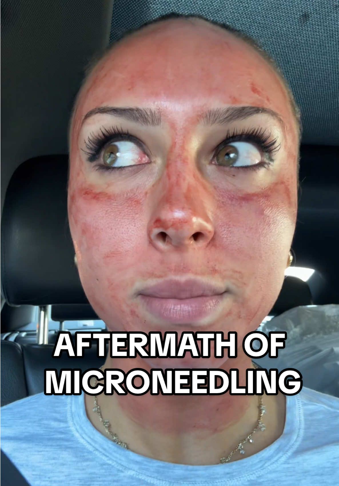 So excited to see the difference keep you posted 