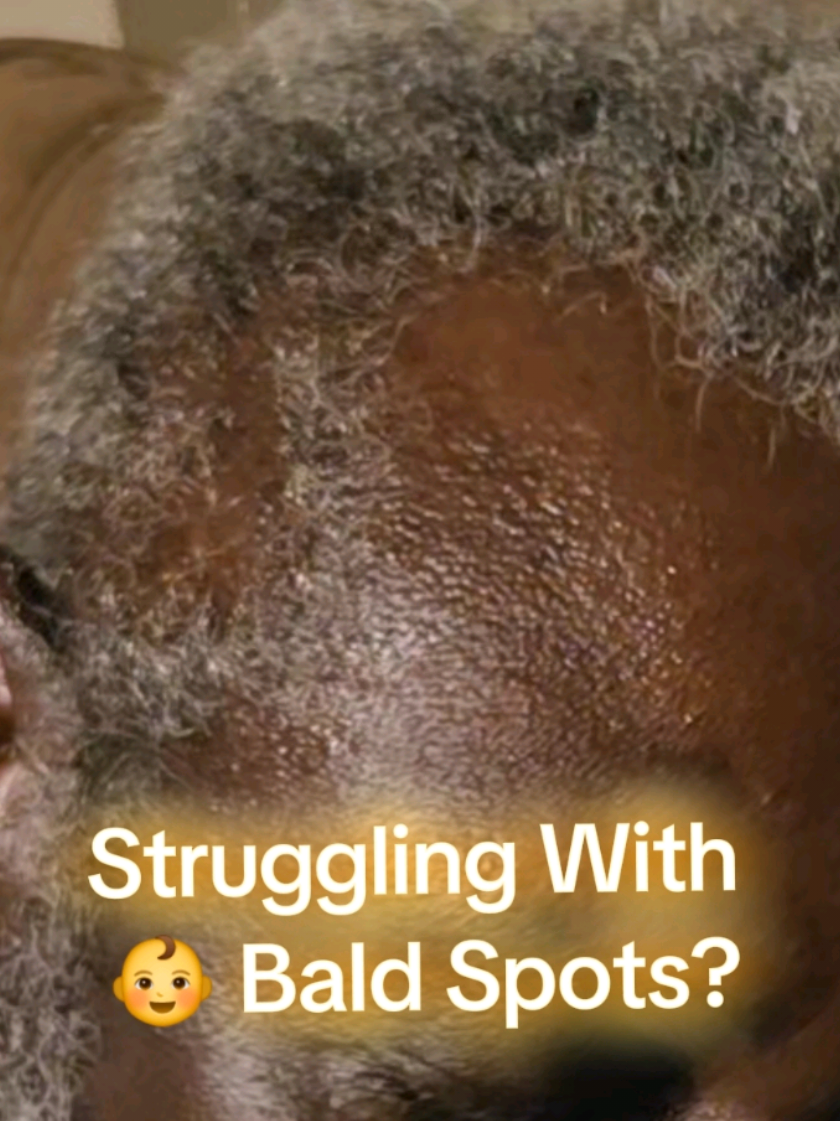 Bald spots and Hair thinning doesn’t have to be permanent — no matter your age😉. Sourced directly from Honduras, this heritage oil hydrates at multiple levels, smooths frizz, strengthens strands, and promotes healthy growth without weighing your hair down. #thinninghairsolutions  #fullerhairnaturally  #healthyhairafter40  #hairgrowthoil  #restoreyourhai 