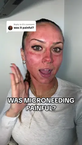Replying to @G let me know if you guys have any more questions!! 🫶🏼 #microneedling #skincare #microneedlingface 