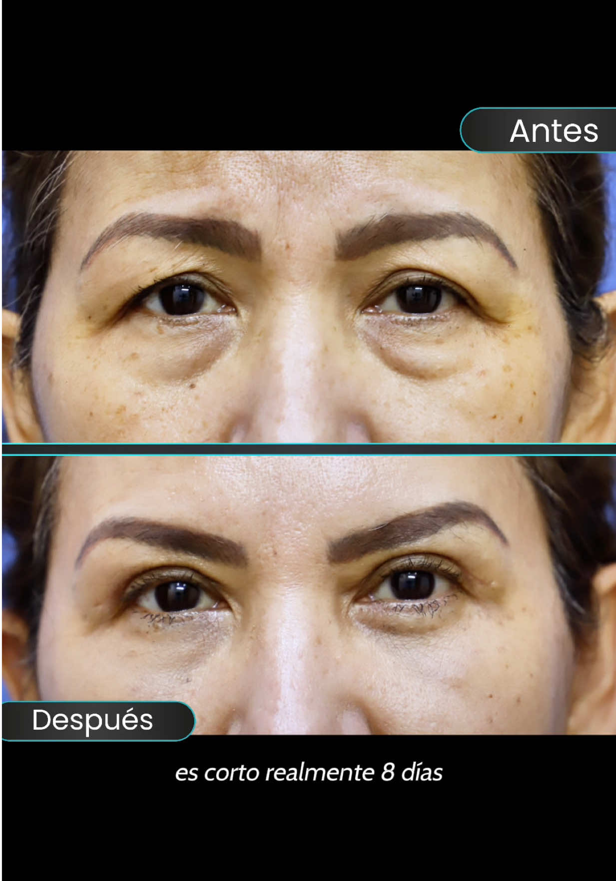 La cirugía que devuelve el poder de tu mirada 👀 la conocías? #cirugia #viral #blefaroplastia #cirugiaparpados #blefaroplastiaencolombia 