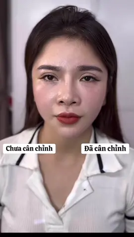 Cân chỉnh tầng mặt giữa #filler #fullface #viral 