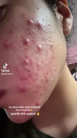i need my face to b like GLASSS #fyppppppppppppppppppppppp #xyzbca #Acne #tretinoin #viral #acneskin 