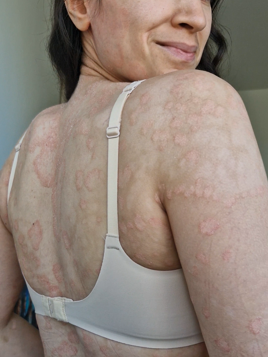 une maladie inflammatoire chronique de la peau 🌸 les cellules se renouvellent trop vite  formant des plaques rouges, épaisses parfois squameuses.  Tu connais le psoriasis ? #psoriasis #psoriasiswarrior #maladiedepeau #autoimmun 