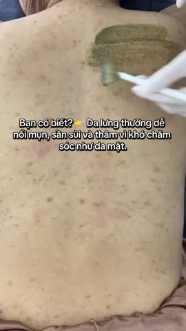 “ Đằng trước xinh rồi, đằng sau cũng phải nuột 😍” #spagovap #ngânskinlab #spanuphemgovap #chemicalpeel #peeltrithamlung 