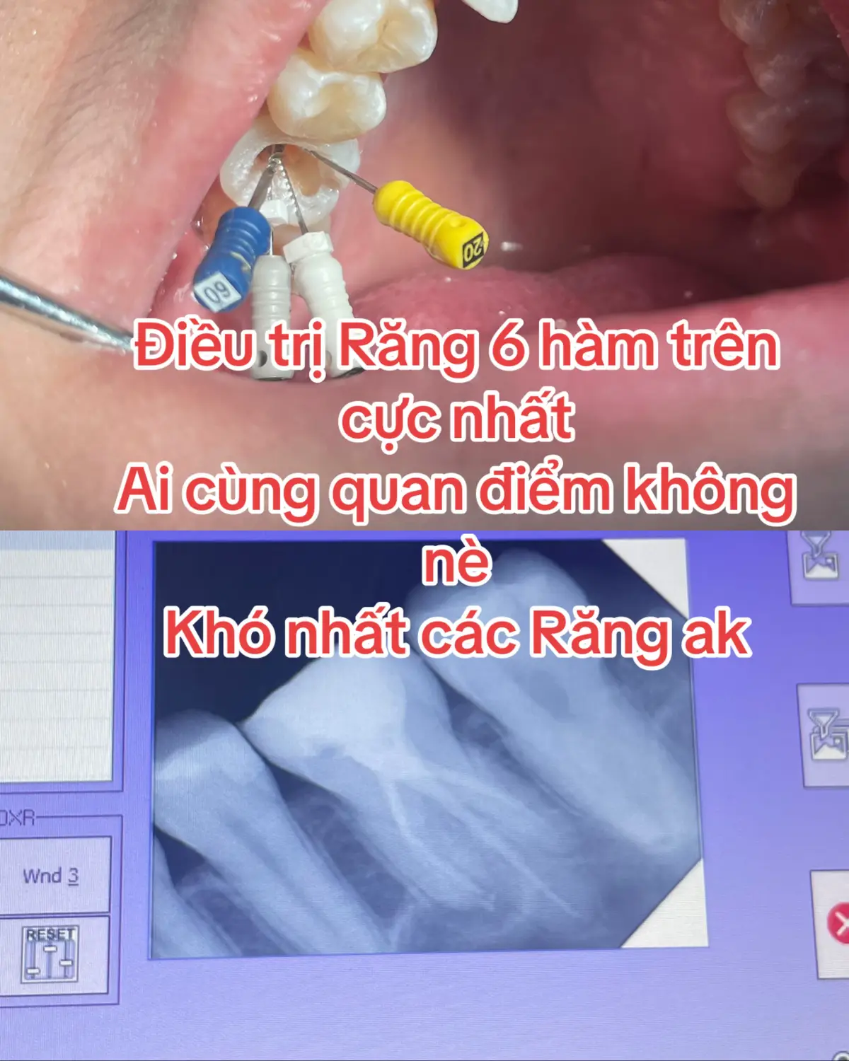 Điều trị Răng 6 hàm trên cực nhất Ai cùng quan điểm không nè Khó nhất các Răng ak#nộinhađiềutrịtuỷchỉ1lầnhẹn #viêmtuy #trám_răng_sâu #răng #nhakhoaankhang 