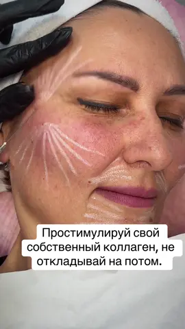 ✨ Хочешь, чтобы кожа сама вырабатывала коллаген? 💉 Полимолочная кислота запускает естественное омоложение изнутри — без “перекачанных” эффектов, только твоя кожа, но моложе 🔥#fyp #collagen #TikTokBeauty #beautyhacks #полимолочнаякислота 