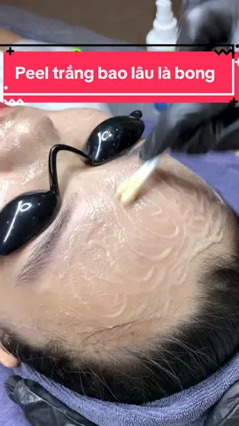 Peel trắng bao lâu là bong#daotaohocvienchuyennghiep #túdoli #mixpeel #trithamnach #thamnach 