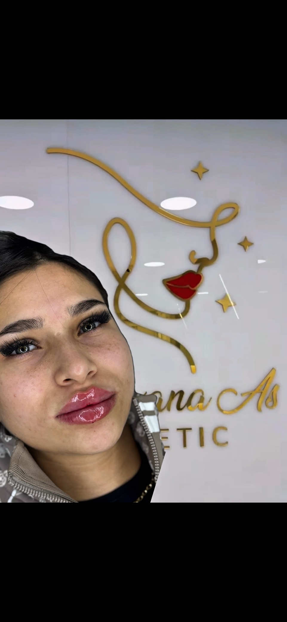 Russian Lips By Dr.Roxana As Aesthetic  ⚡️Pachet SUBLIME - topire AH + reinjectare 1 AH - 1290 lei redus de la 1990 lei  ⚜️Pachet LOFTY - augumentare buze 1 ml + alungire bărbie - 2000 lei redus de la 3000 lei 🫦💉Pachete PROMOȚIONALE Acid & Botox  ✔️1 ml acid - Revolax - 990 lei redus de la 1300 lei - consultație + anestezie + injectare ✔️Pachet 1ml Revolax + 3 zone botox 1790 redus de la 2790 lei - consultație + anestezie + injectare  #lipfiller #lipfillers #beforeandafter #lipinjections #beauty