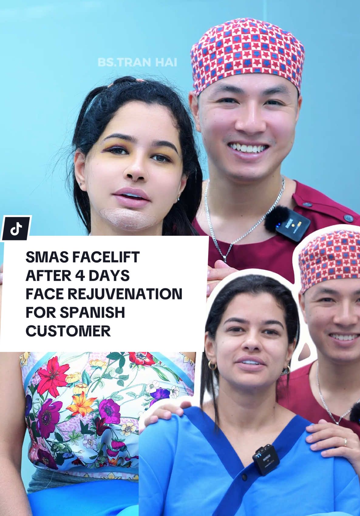 SMAS FACELIFT AFTER 4 DAYS, FACE REJUVENATION FOR SPANISH CUSTOMER #facelifting #facelift #xuhuong #xuhuongtiktok #spain 