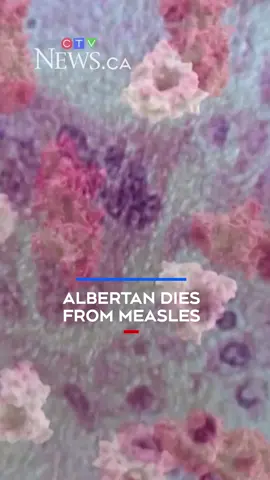 An Albertan has died from complications due to measles, government data released Thursday says.   According to the latest update on the Alberta government’s measles data information page, one person has died from the illness.  There is no further information about the patient. #ctvnews #news #canada