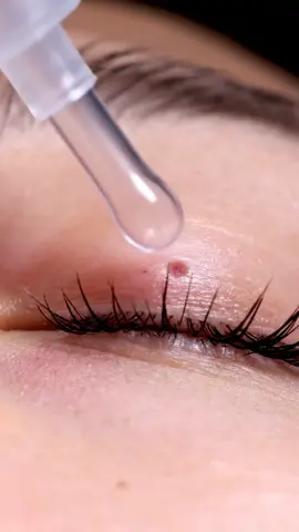 Removing stubborn blackheads the satisfying way #blackheads #skincarevideosReal clinic-style skincare — clean, calm, and ultra-realistic ❤️  #blackheads #blackheadremoval #skincare #pimplepopping #extraction #satisfyingvideos #skincareroutine #deepcleansing #facialtreatment #skincareclinic #estheticianlife #dermatologist #clearskin #skincarevideos #pores #skincarelover #blackheadextraction #skincareobsessed #beautycare #skincaregoals #reels #reelsskincare #reelstrending #instagramreels