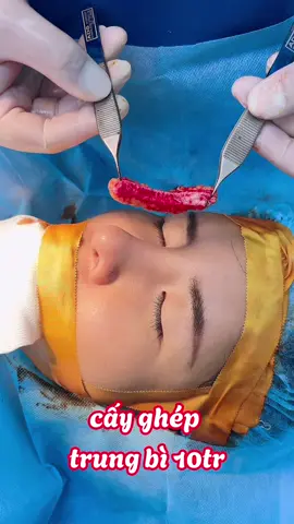 tháo sụn cấy ghép trung bì mũi 10tr...