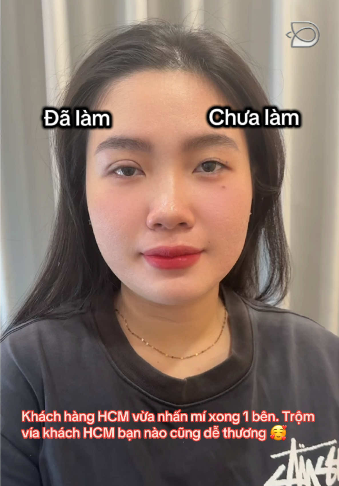 👉🏻 Cận cảnh chiếc mí mới nhấn xong cho em gái khách hàng HCM, trộm vía không s.ưng không bị b.ầm tím chút nào nha 🥰 👉🏻 Nhanh tay INBOX gửi hình ảnh Thuỷ tư vấn form mí phù hợp cho bạn nha! #lamdep #nhanmi #thammy #viral #fyp 