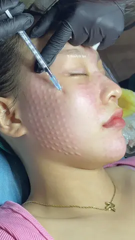 Rưng rưng chứ chưa rơi 🥹#tl_beauty_spa #Meso_căng_bóng_trắng_sáng #meso_phục_hồi #tiêm_meso #xh 