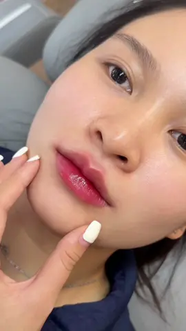 Cộng 1 gái có môi xinh chưa tới 1cc #tiemmoi #moibaby #moidep #filler #xuhuong 