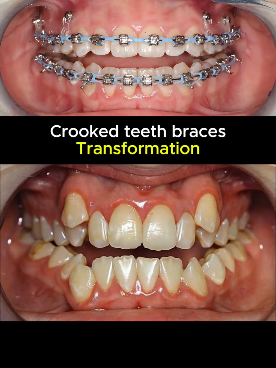 Có hàm răng khấp khểnh cỡ này :) #niengrang #braces #niengrangdepconao #nhakhoa 