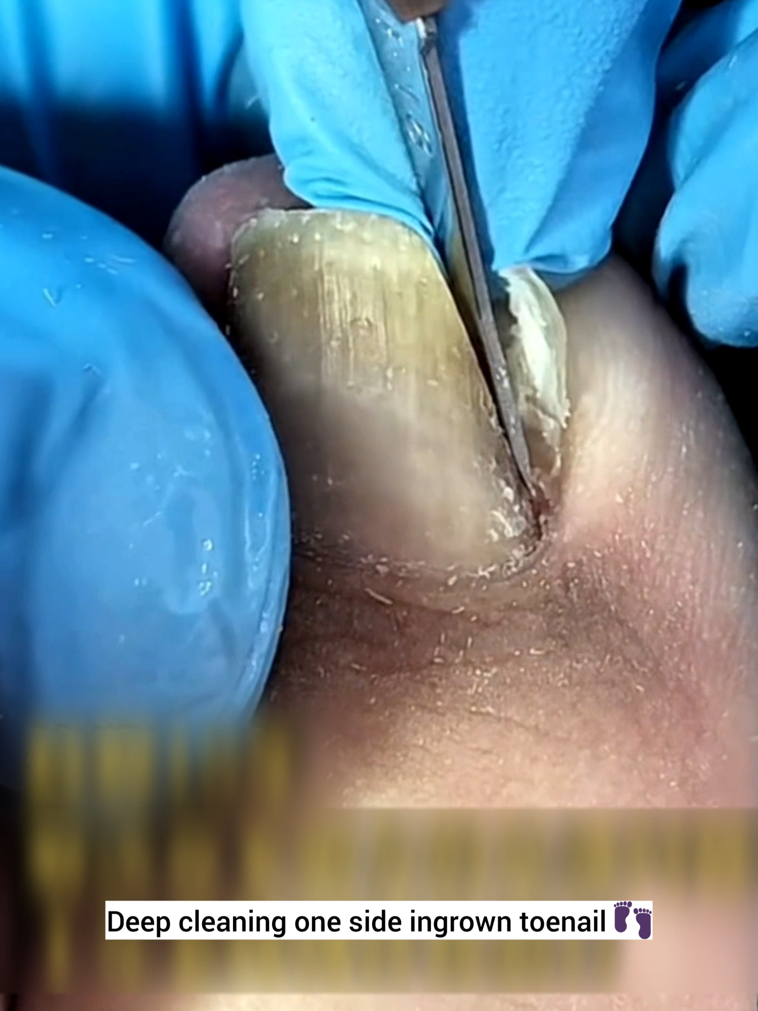 Removing painful edge of big toe nail 💪 #footcare#nailtreatment #trending #viral