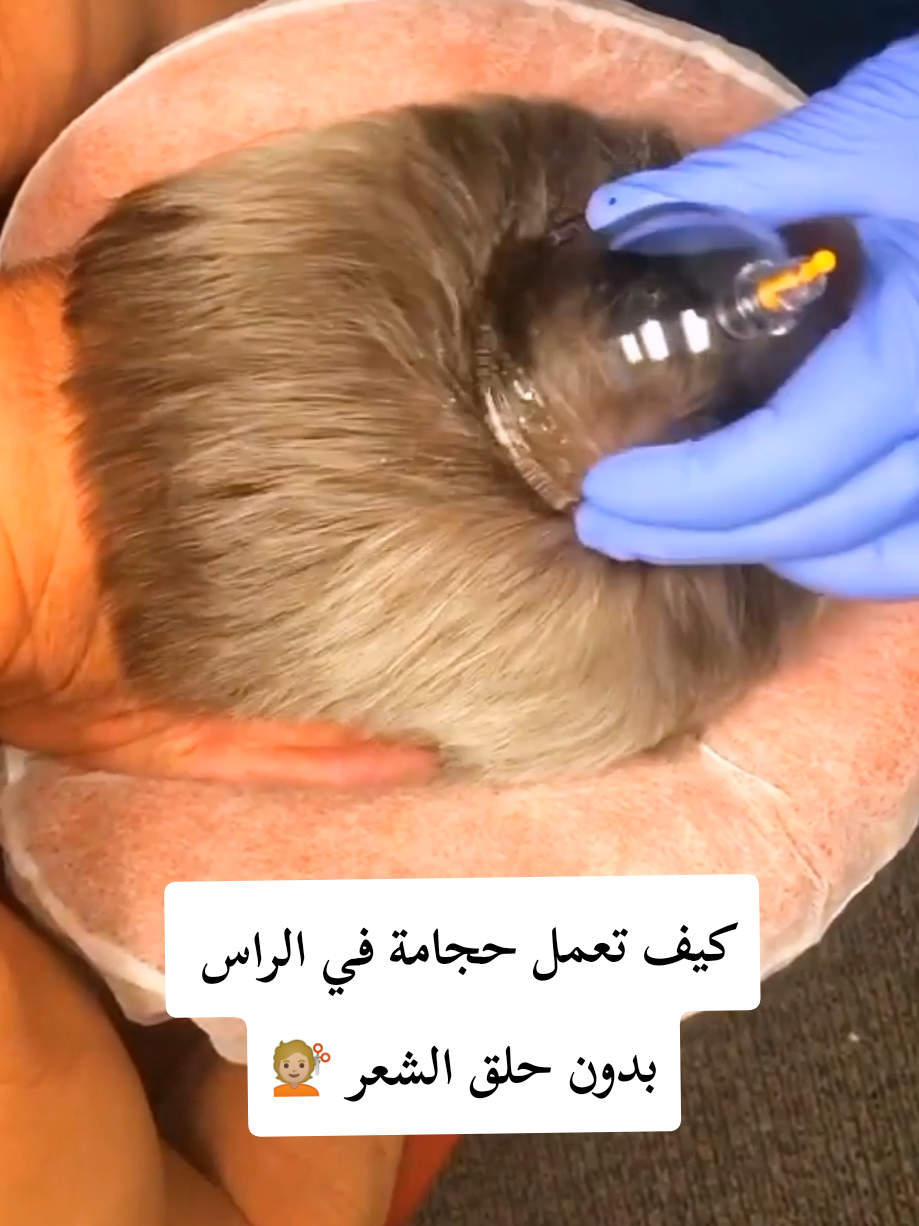 كيف تعمل حجامة في الراس بدون حلق الشعر 💇🏼 #الحجامة_النبوية #حجامة_طنجة #cupping #طنجة #hijama 