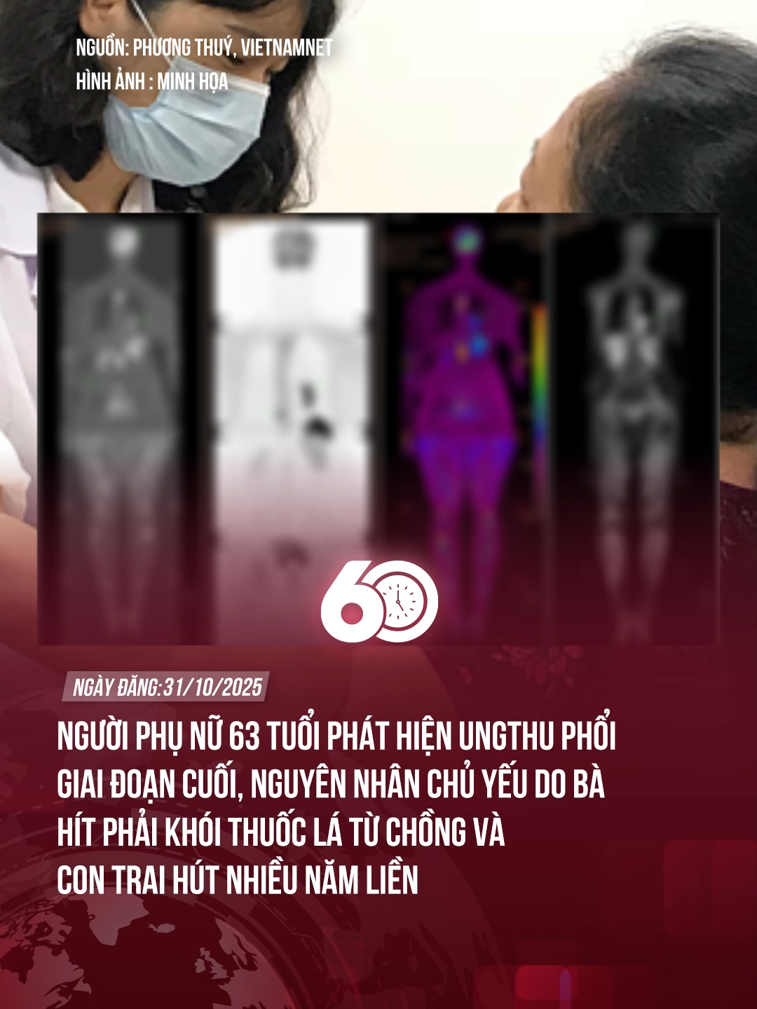 NGƯỜI PHỤ NỮ 63 TUỔI PHÁT HIỆN UNGTHU PHỔI GIAI ĐOẠN CUỐI, NGUYÊN NHÂN CHỦ YẾU DO BÀ HÍT PHẢI KHÓI THUỐC LÁ TỪ CHỒNG VÀ CON TRAI HÚT NHIỀU NĂM LIỀN #theanh28 #60giay #tiktoknews