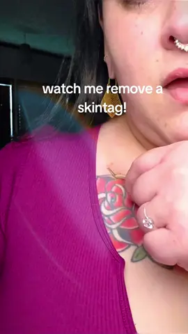 #fyppppppppppppppppppppppp #beauty #beautypenuer #skintag #remove  
